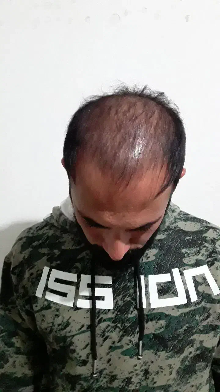 کاشت مو و ابرو|خدمات آرایشگری و زیبایی|قم, پامنار|دیوار