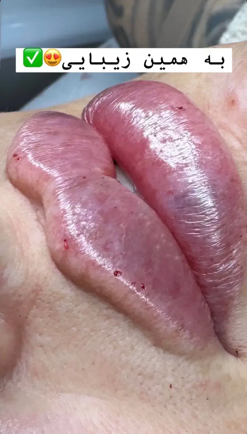 جشنواره تخفیف ژل لب و بوتاکس|خدمات آرایشگری و زیبایی|کرج, خرمدشت|دیوار