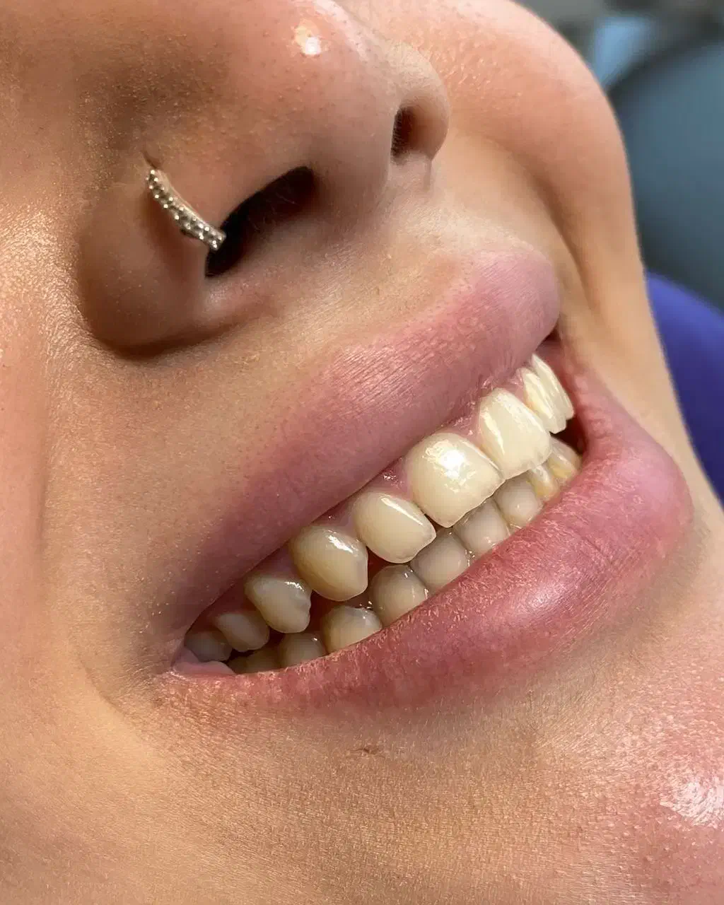 دندان کامپوزیت دندانپزشکی باهوش مصنوعی|خدمات آرایشگری و زیبایی|مشهد, دانشجو|دیوار