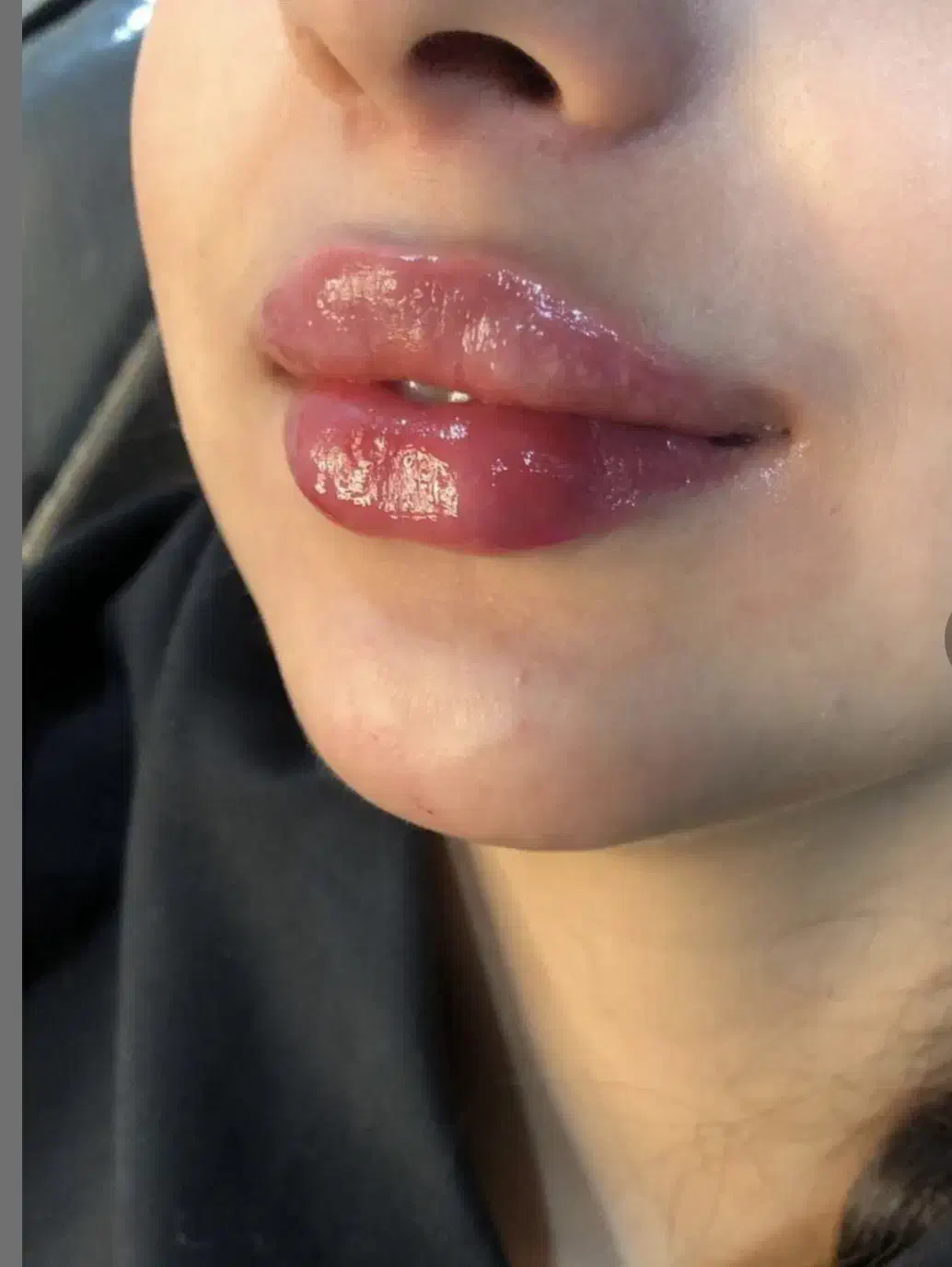 ژل وبوتاکس فیلرمزوپی ارپی آنزیم هایفوبلفاروپلاستی|خدمات آرایشگری و زیبایی|تبریز, |دیوار