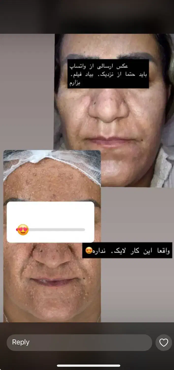 ابرسانی عمیق پوست به صورت تزریقی فقط ۱۴۰۰|خدمات آرایشگری و زیبایی|یاسوج, |دیوار