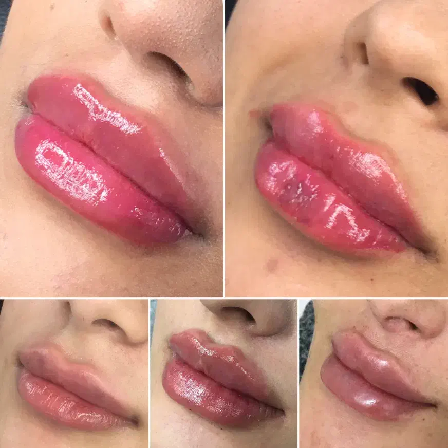 بوتاکس، فیلر و خدمات پیرسینگ|خدمات آرایشگری و زیبایی|رشت, خواهر امام|دیوار