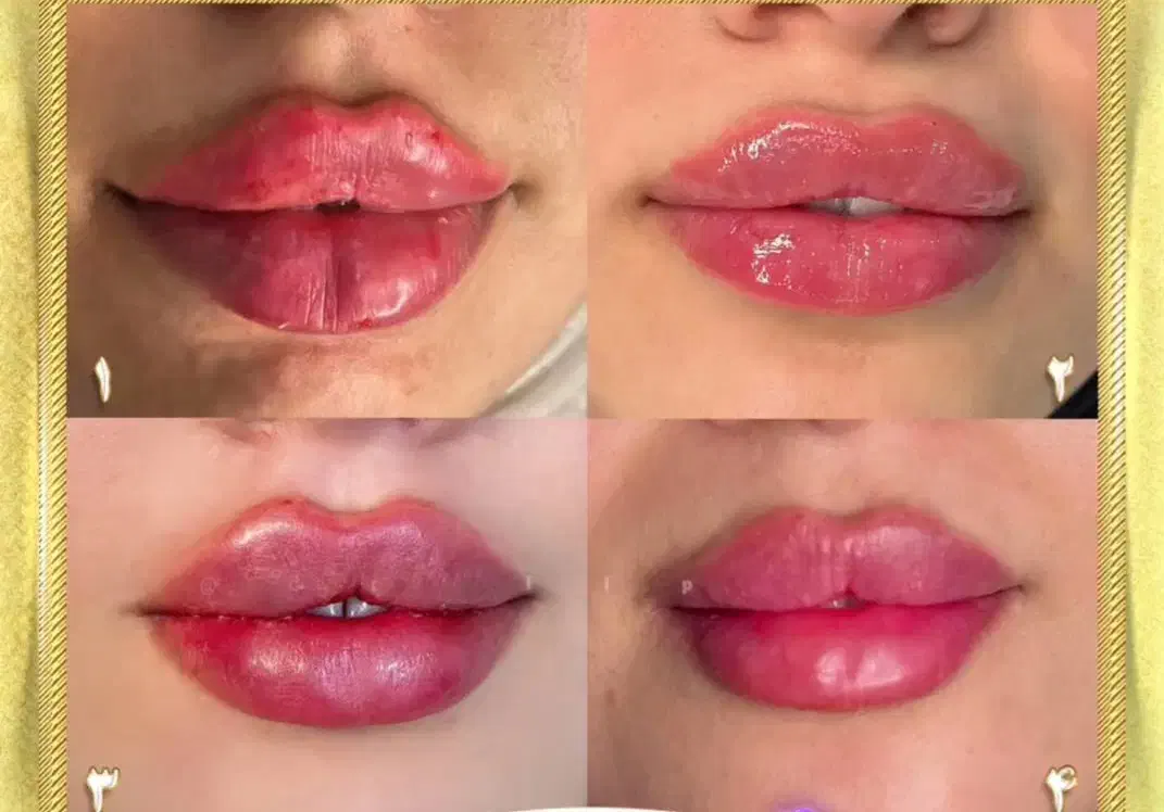 تزریق ژل وبوتاکیس|خدمات آرایشگری و زیبایی|بجنورد, |دیوار