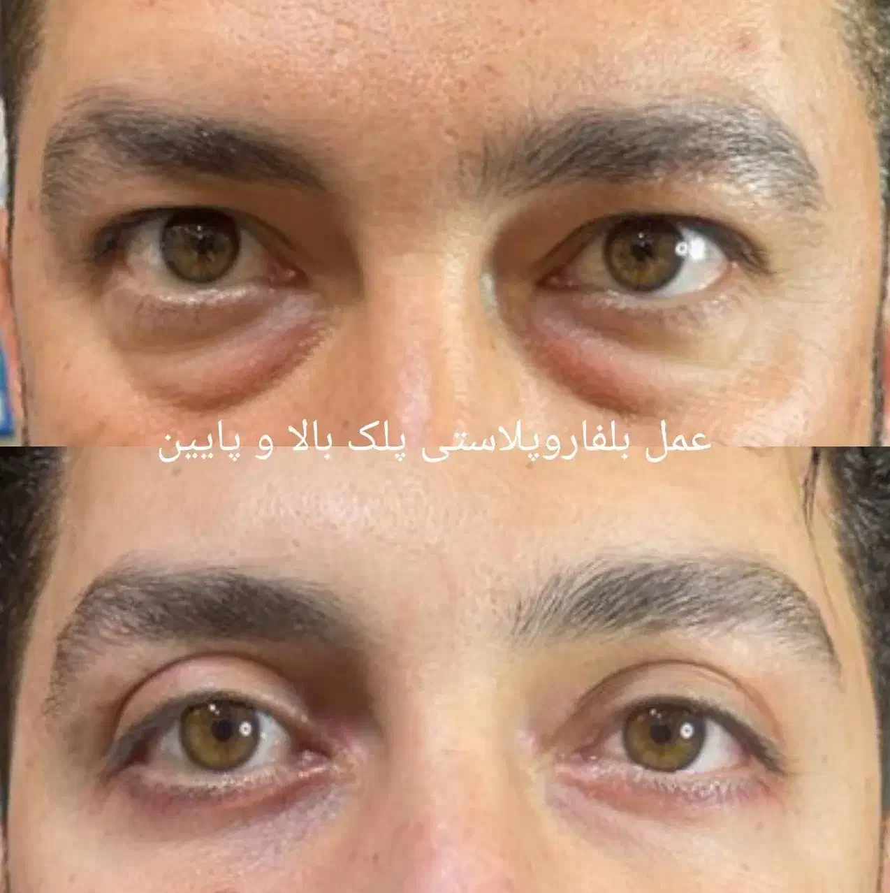 جشنواره بلفاروپلاستی پلک غبغب سانترال ژل چربی|خدمات آرایشگری و زیبایی|قم, بلوار امین و ساحلی|دیوار
