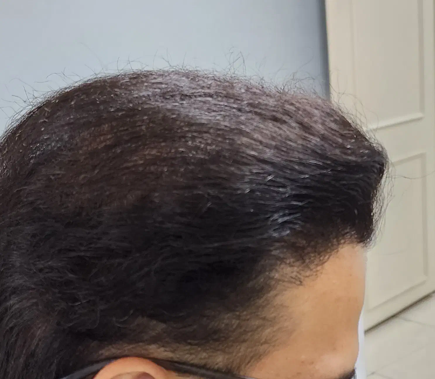 کاشت مو تخصصی|خدمات آرایشگری و زیبایی|اسکو, |دیوار