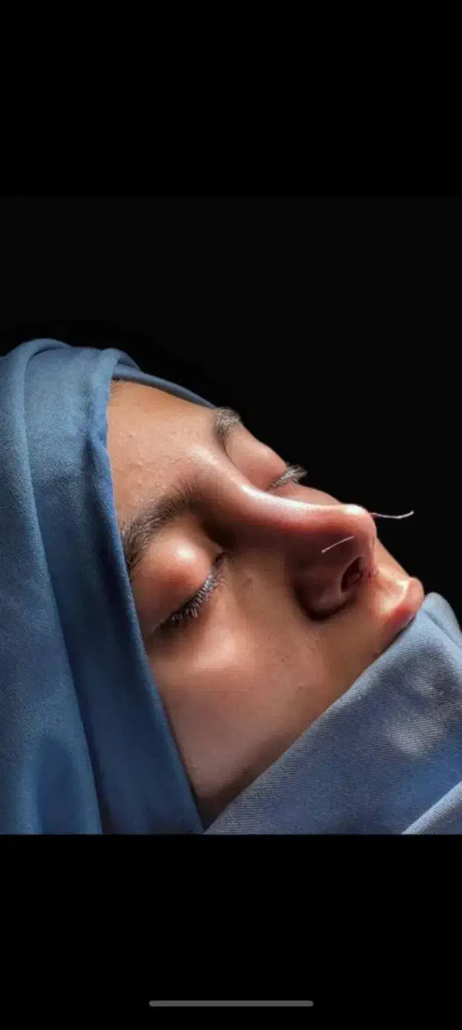 جنشواره عمل بینی|خدمات آرایشگری و زیبایی|حمیدیه, |دیوار