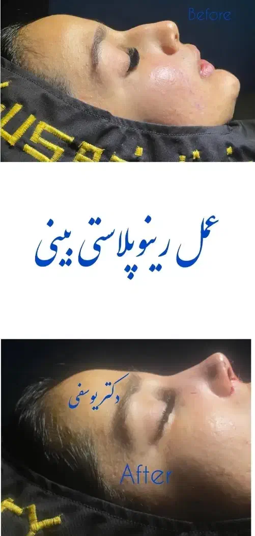 جشنواره ویژه جراحی بینی رینوپلاستی قیمت استثنایی|خدمات آرایشگری و زیبایی|جوانرود, |دیوار