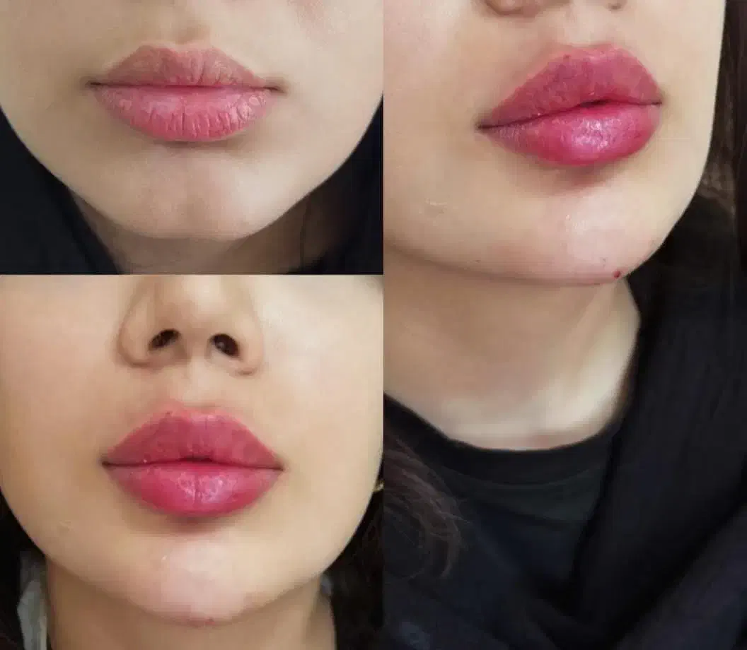 تزریق ژل و آنزیم غبغب وبینی وتزریق آنزیم تخلیه ژل|خدمات آرایشگری و زیبایی|اردبیل, |دیوار