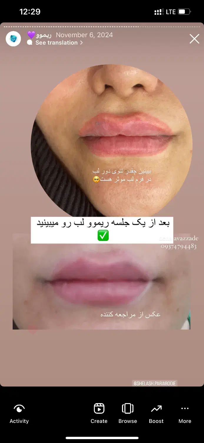 ریموو،پاک کردن تتوی صورت|خدمات آرایشگری و زیبایی|دوگنبدان, |دیوار