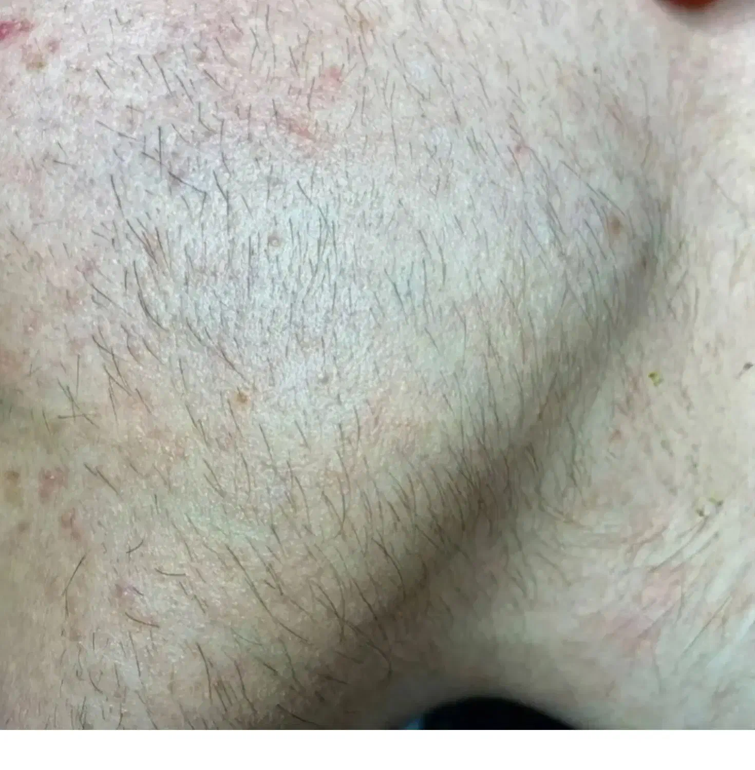 الکترولیز تنها روش قطعی از بین بردن هر نوع مو|خدمات آرایشگری و زیبایی|صدرا-فارس, فاز ۱|دیوار