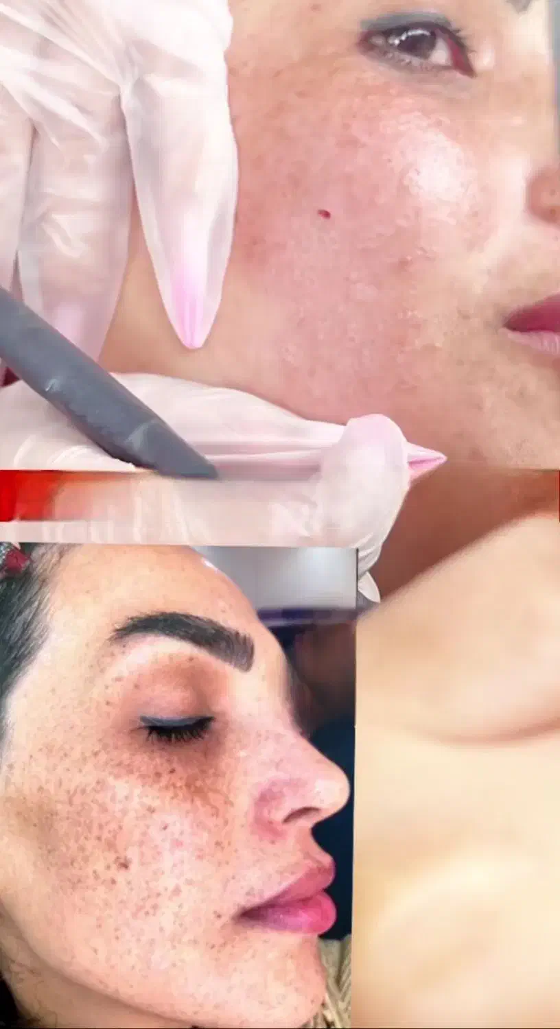 درمان تخصصی لک و کک و مک|خدمات آرایشگری و زیبایی|ساری, |دیوار