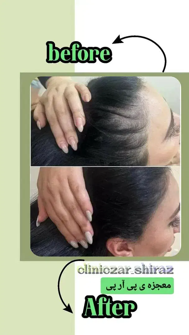 خدمات زیبایی بوتاکس ژل مزو لیزر تخفیف ویژه|خدمات آرایشگری و زیبایی|شیراز, فضل‌آباد|دیوار