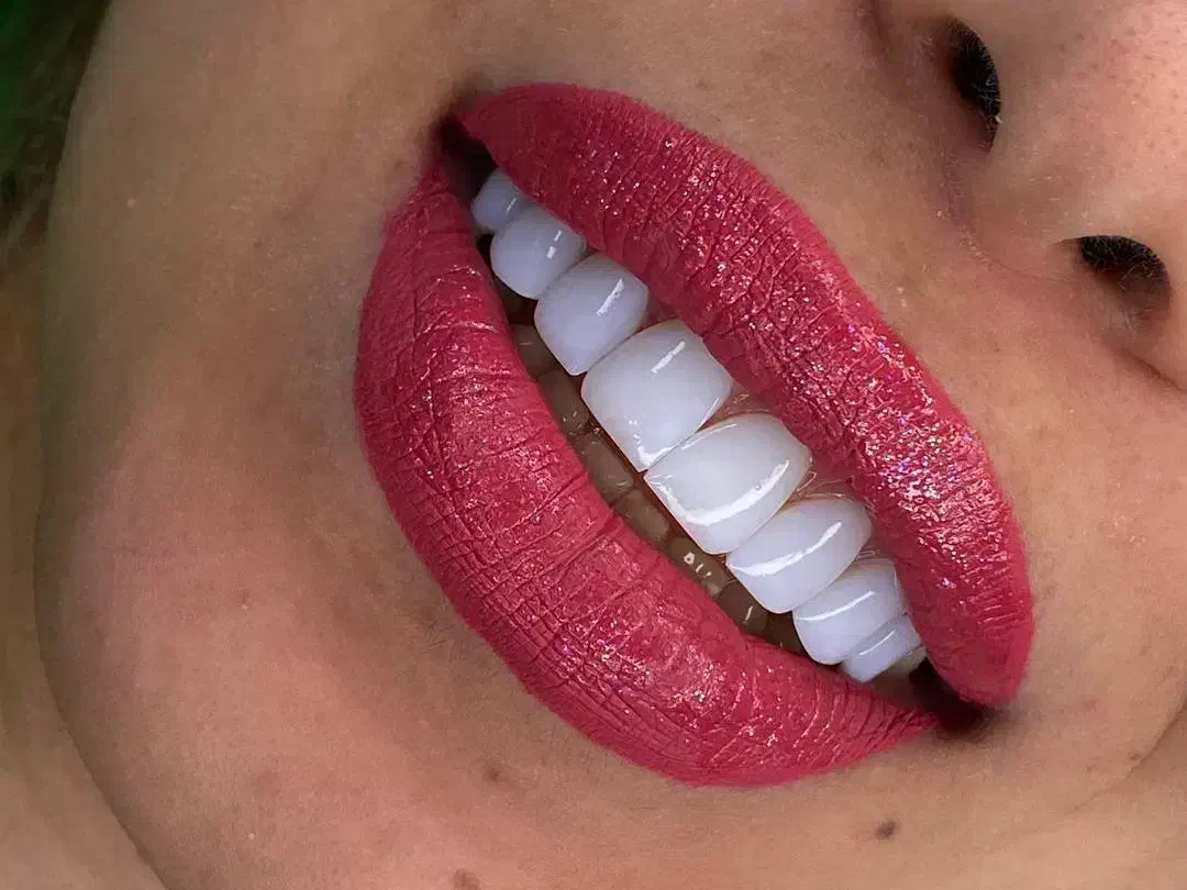 کامپوزیت دندان لیزرمو ژل بوتاکس فیلر مزو پی ارپی|خدمات آرایشگری و زیبایی|اسلامشهر, زرافشان|دیوار