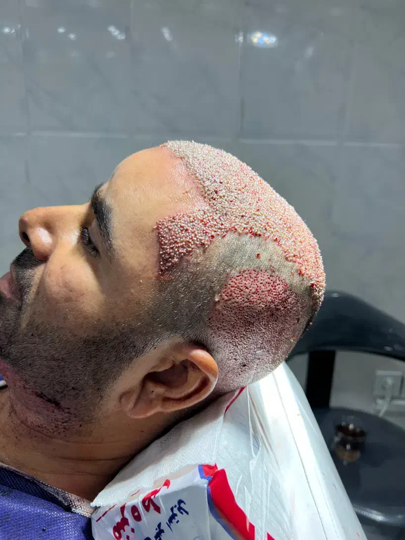 آموزش و استخدام تکنسین کاشت مو|استخدام درمانی، زیبایی، بهداشتی|شیراز, چوگیاه‎|دیوار