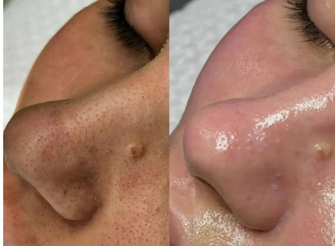 تخفیف یلدایی پاکسازی پوست فقط ۵۰۰تومن|خدمات آرایشگری و زیبایی|محمدیه-قزوین, |دیوار