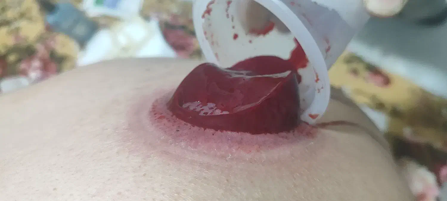 حجامت بادکش.طب سنتی برداشت خال وبا پزشک|خدمات آرایشگری و زیبایی|شیراز, دشت چنار|دیوار