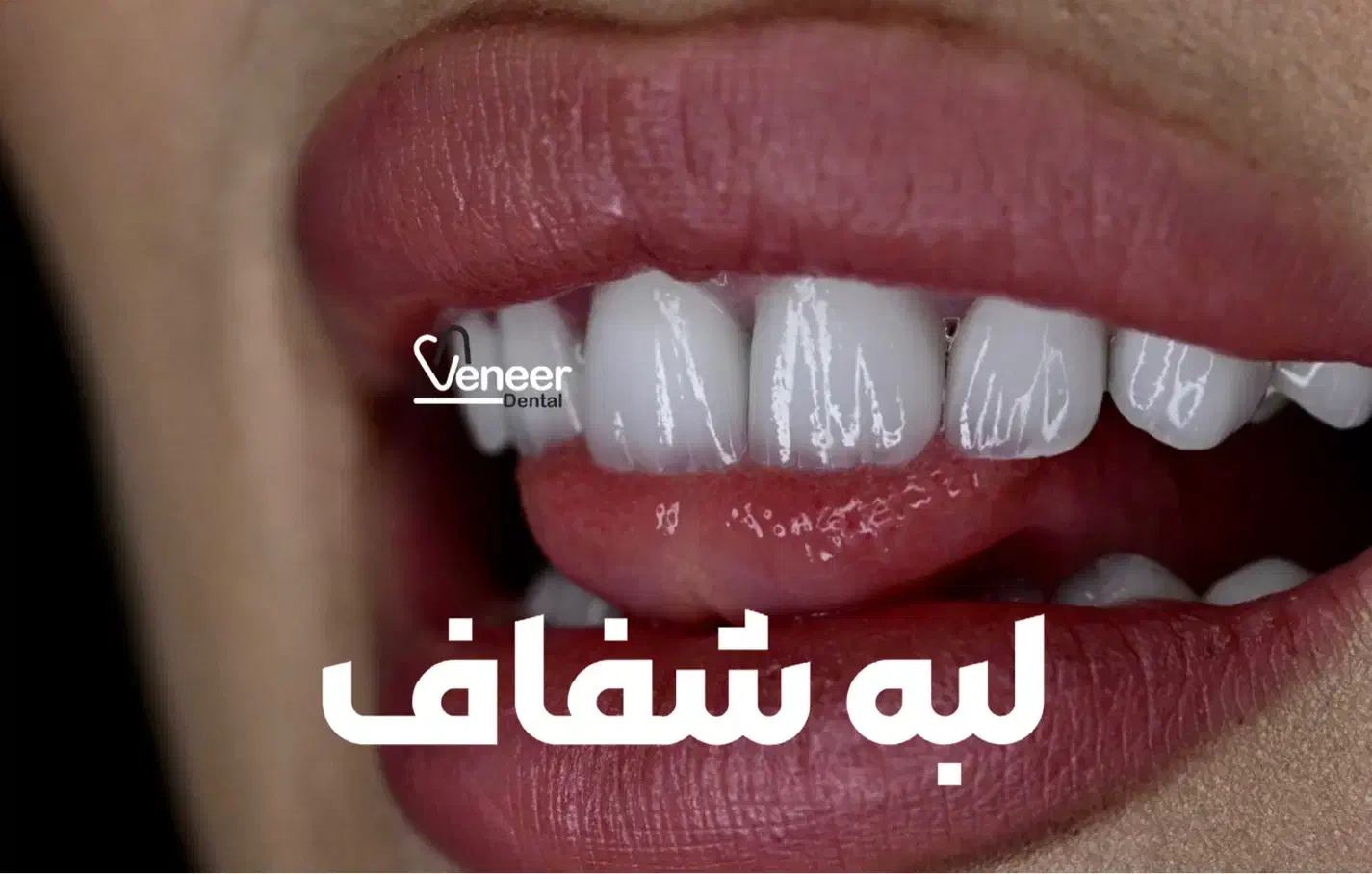 دندانپزشکی لمینت الهیه منطقه ۱ کامپوزیت سرامیکی|خدمات آرایشگری و زیبایی|تهران, الهیه|دیوار