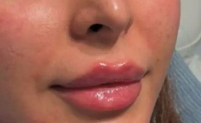 ترزیق ژل و بوتاکس،تخصصی و تضمینی|خدمات آرایشگری و زیبایی|نورآباد, |دیوار