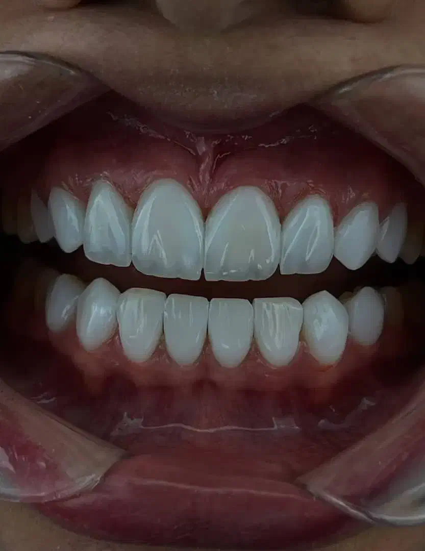 کامپوزیت.لمینت|خدمات آرایشگری و زیبایی|تهران, هفت حوض|دیوار