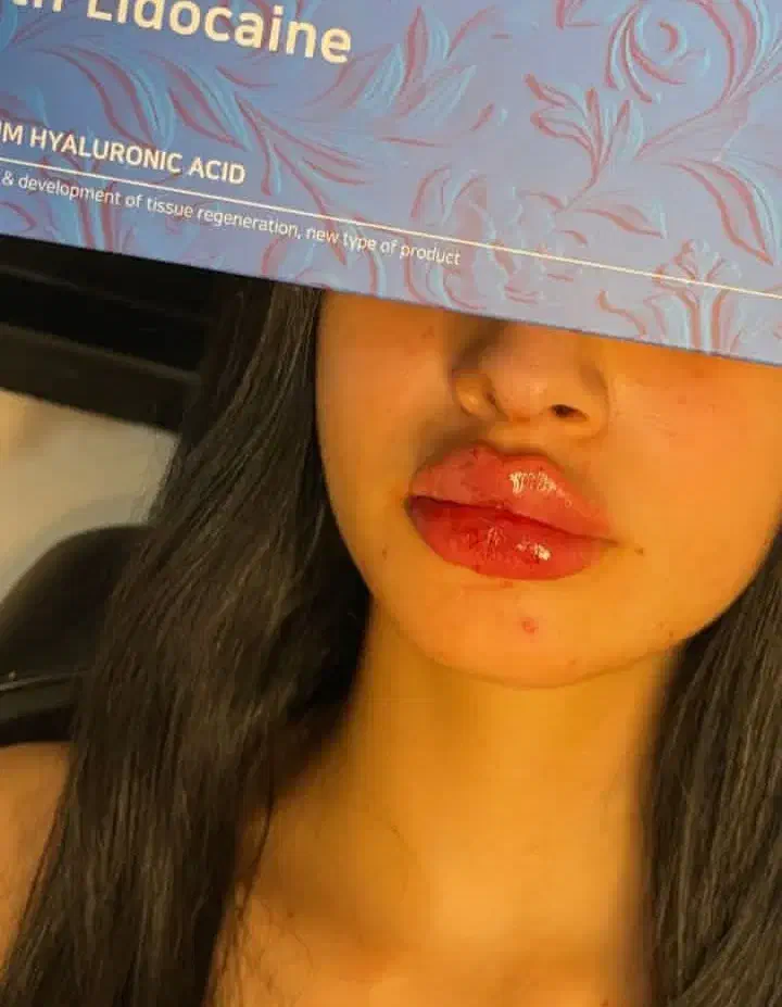 آف یلدایی ژل و بوتاکس|خدمات آرایشگری و زیبایی|دورود, |دیوار