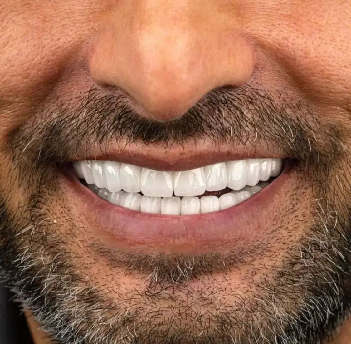 تخفیف ایمپلنت   شرایط ویژه دندانپزشکی|خدمات آرایشگری و زیبایی|اسکو, |دیوار