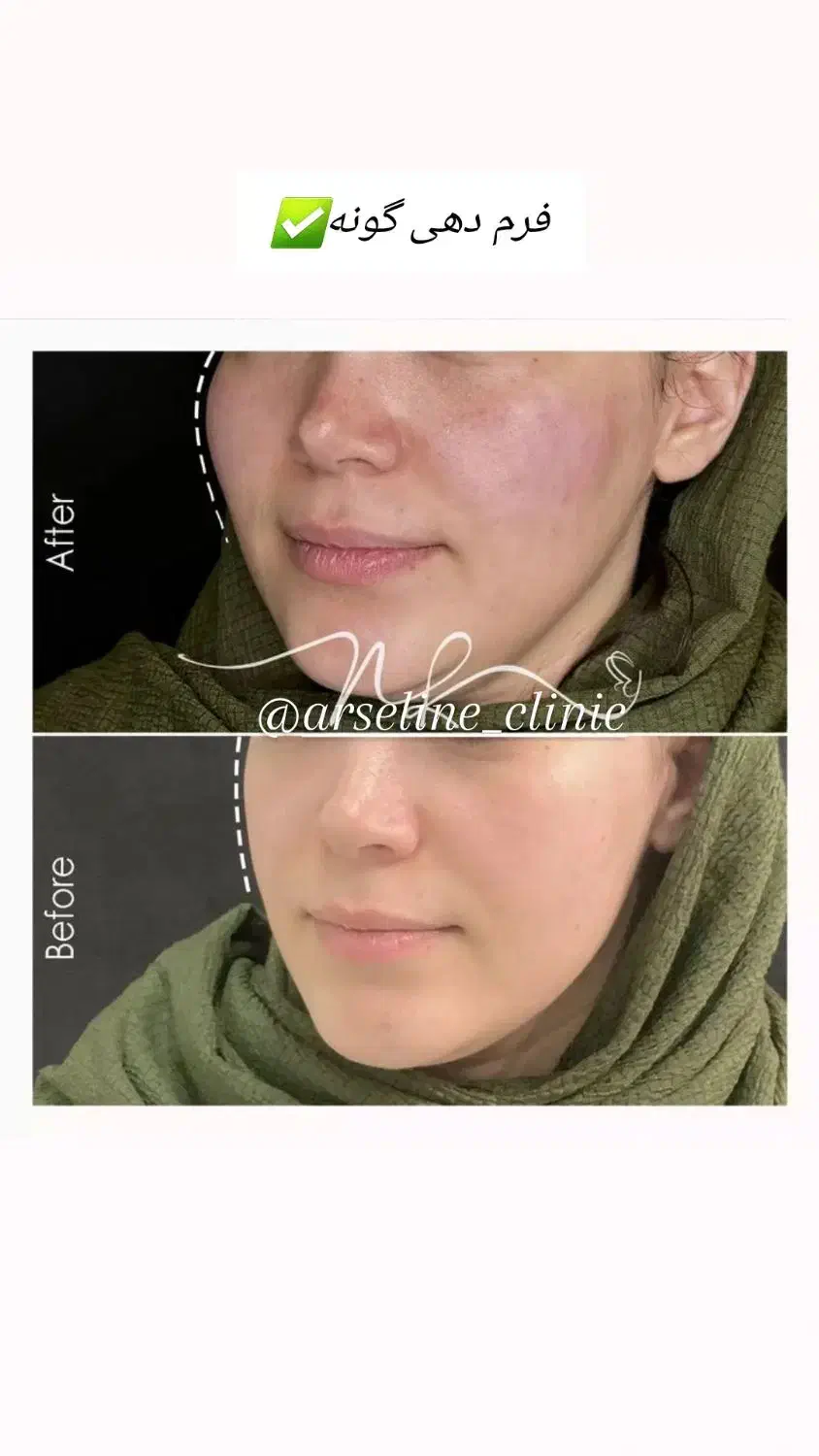 آموزش فیلر،بوتاکس،مزو،مزو ژل با مدرک|خدمات آموزشی|آبادان, |دیوار