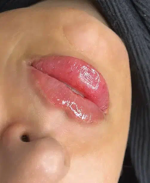 تخفیف ویژه تزریق فیلر|خدمات آرایشگری و زیبایی|اندیشه, اندیشه فاز ۱|دیوار