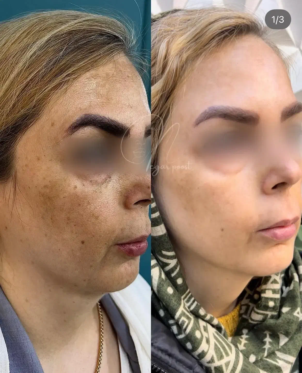 مدل جهت کار درمان تلفیقی پوست|خدمات آرایشگری و زیبایی|چالوس, |دیوار