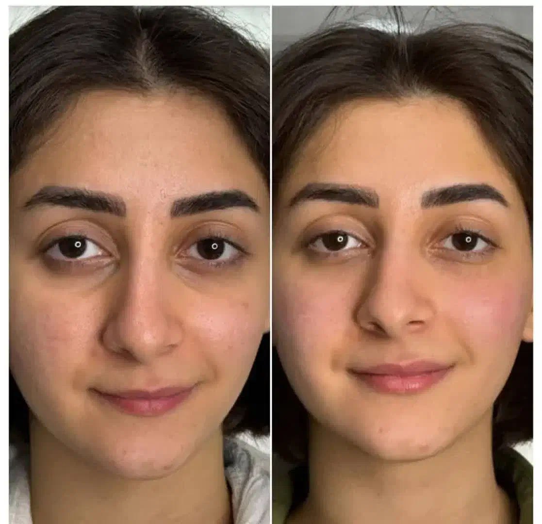 زیبایی لیفت بلفارو فرم بینی بوتاکس نخ ابروزاویه ژل|خدمات آرایشگری و زیبایی|اصفهان, خانه اصفهان|دیوار