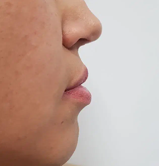 مدل ژل و بوتاکس|خدمات آرایشگری و زیبایی|قم, باسکول|دیوار