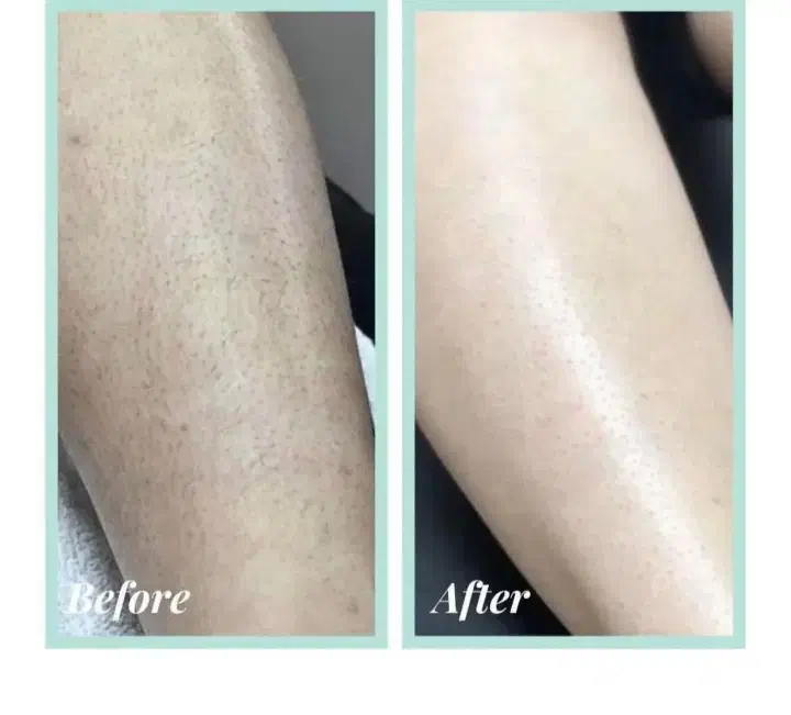 درمان کامل موبدن با لیزرالکس|خدمات آرایشگری و زیبایی|مشهد, شهید فرامرز عباسی|دیوار