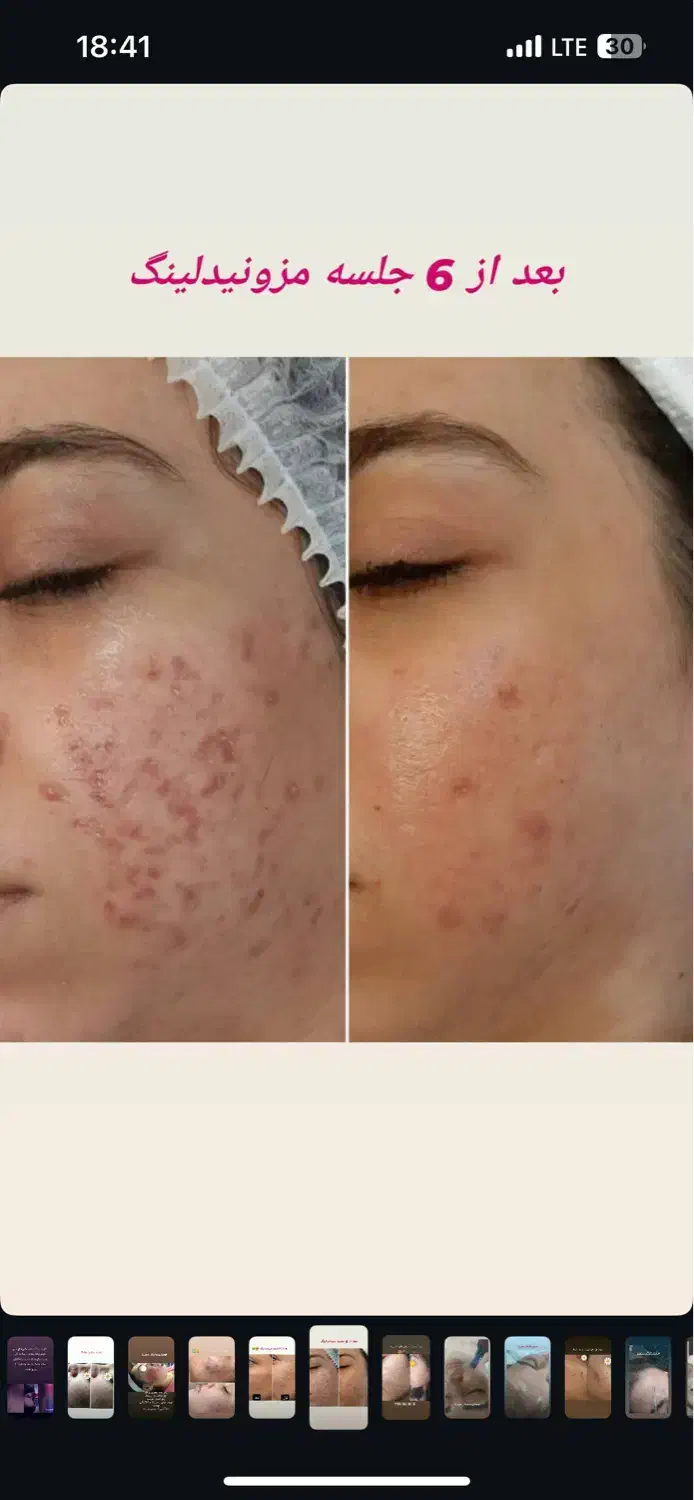 فیشال و مزونیدلینگ پوست و لیفت مژه ابرو و کاشت مژه|خدمات آرایشگری و زیبایی|تهران, تهرانپارس غربی|دیوار