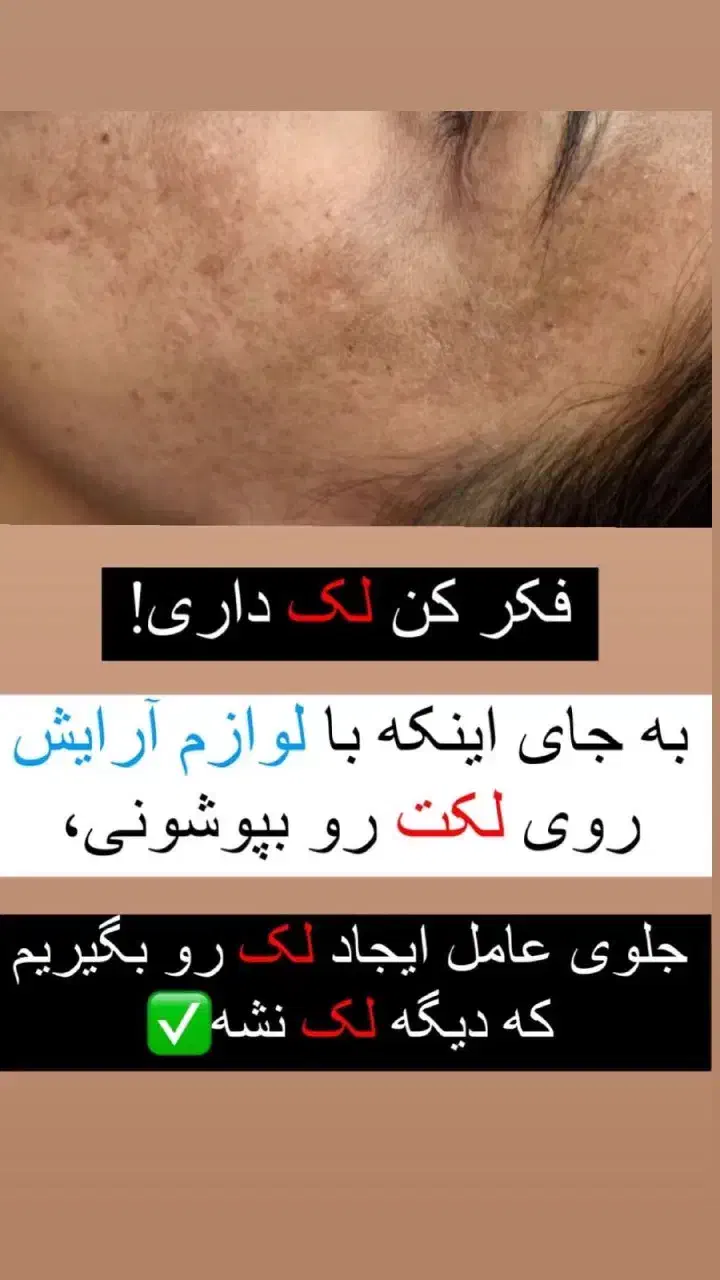 کرم ضد لک لاکچری کویین|آرایشی، بهداشتی، درمانی|بوئین زهرا, |دیوار