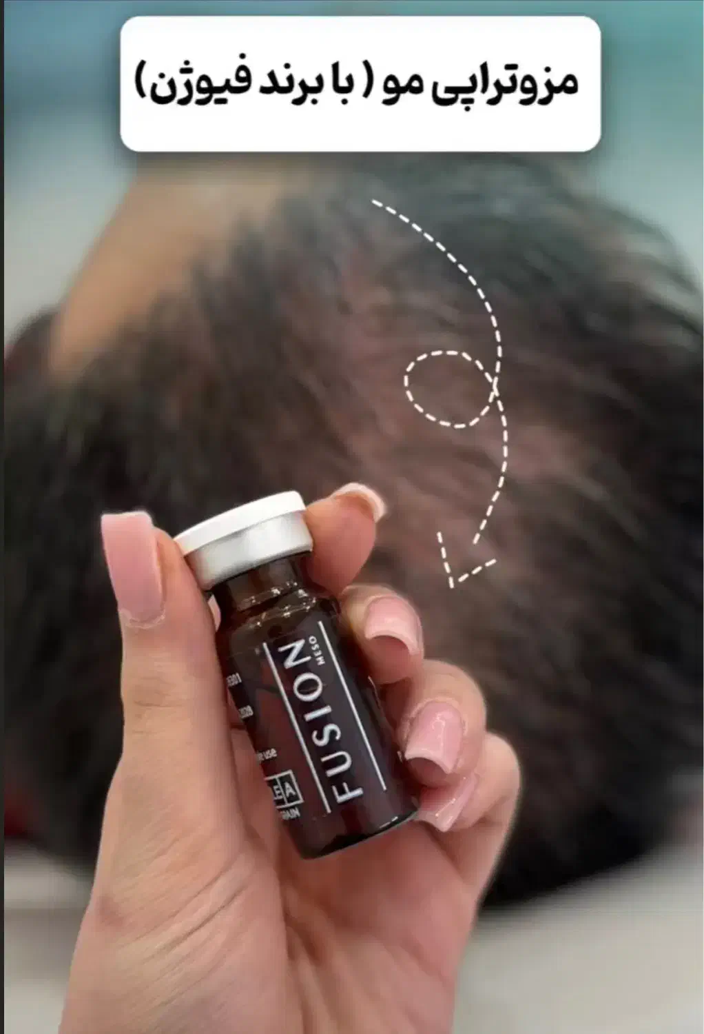 تزریق ژل و انواع مزو ژل های جوانساز|خدمات آرایشگری و زیبایی|بوشهر, |دیوار