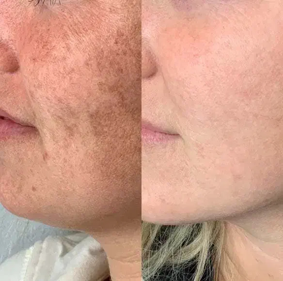 مدل رایگان برای رفع لک پوست با کرم ضدلک + مزو صورت|خدمات آرایشگری و زیبایی|شیراز, جوادیه|دیوار