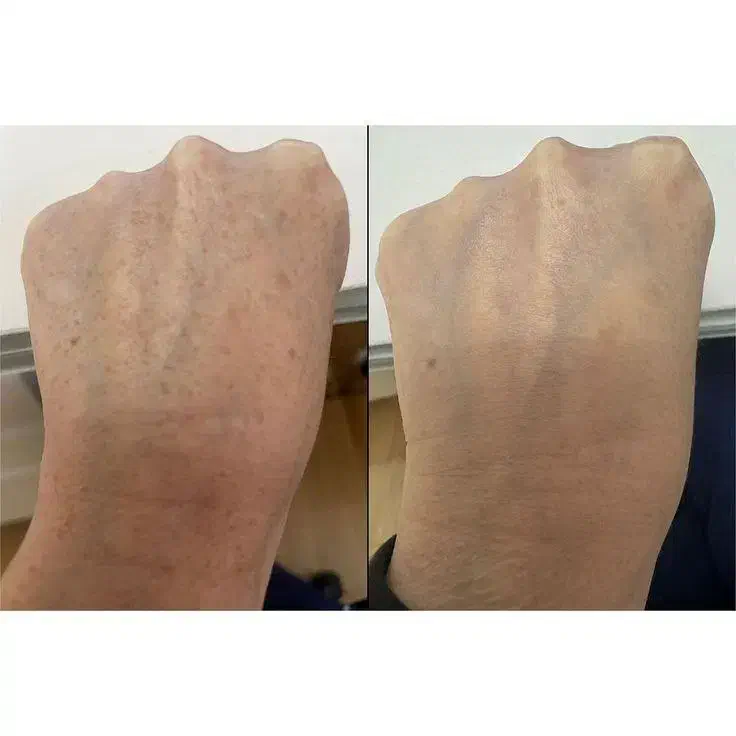 روشن شدن صورت و بدن تضمینی|آرایشی، بهداشتی، درمانی|پارسآباد, |دیوار