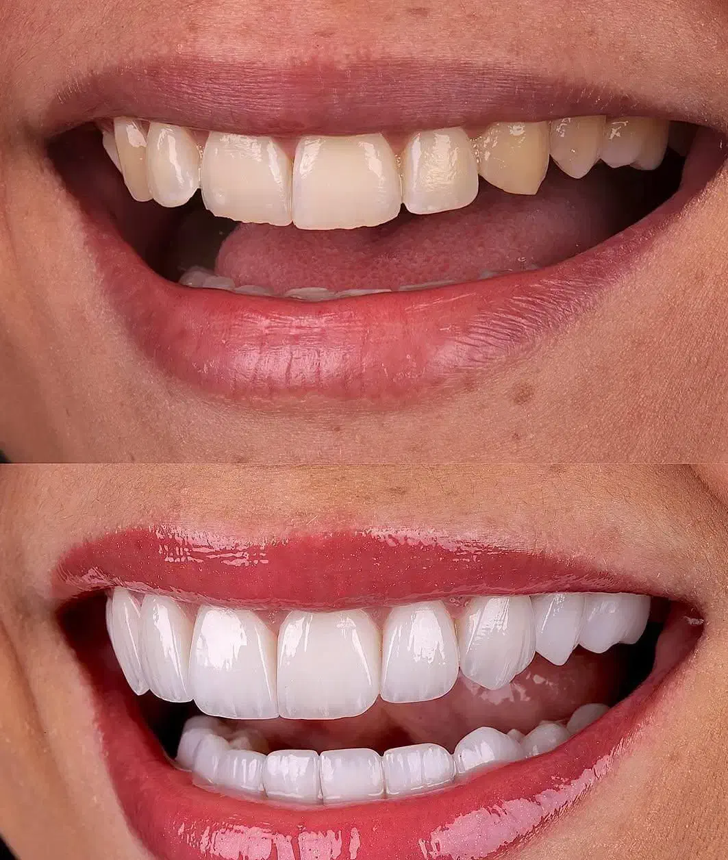 دندان مصنوعی تحویل( ۵ساعته)،کامپوزیت دندان ، روکش|خدمات آرایشگری و زیبایی|تهران, میدان ولیعصر|دیوار