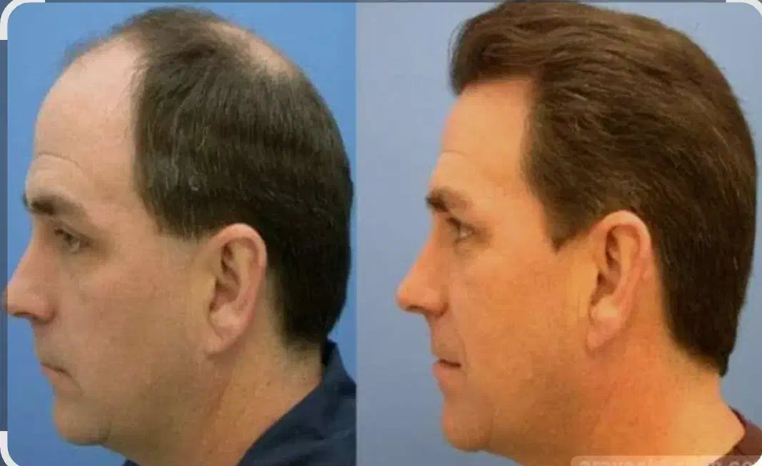 کاشت موی طبیعی و تضمینی، تزریق ژل و بوتاکس  ،|خدمات آرایشگری و زیبایی|تبریز, |دیوار