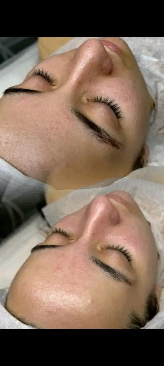 فیشال و پاکسازی پوست|خدمات آرایشگری و زیبایی|نیشابور, هفده شهریور|دیوار