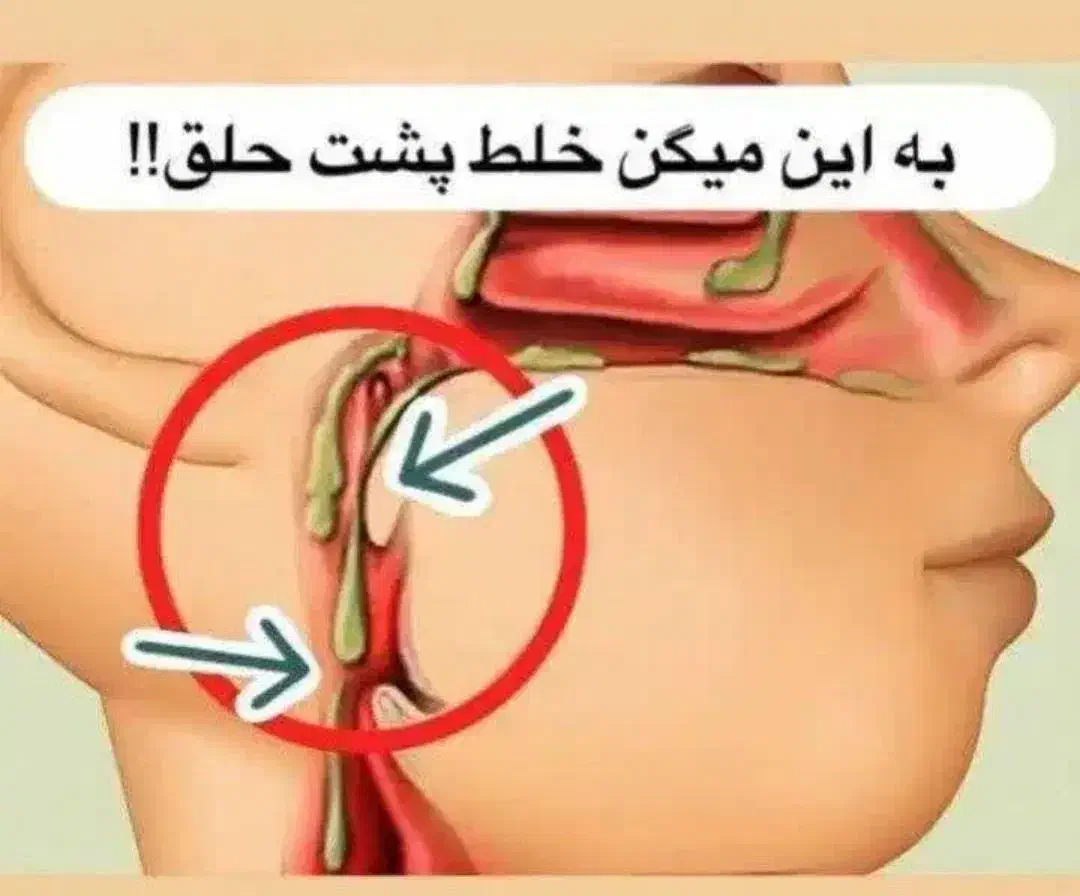 درمان خلط پشت حلق|آرایشی، بهداشتی، درمانی|همدان, |دیوار