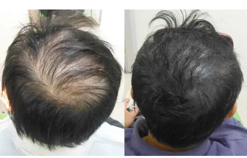 با تکنیک میکرواسکالپ،کم پشتی مو دیگه دیده نمیشه|خدمات آرایشگری و زیبایی|شاهین‌شهر, فردوسی|دیوار