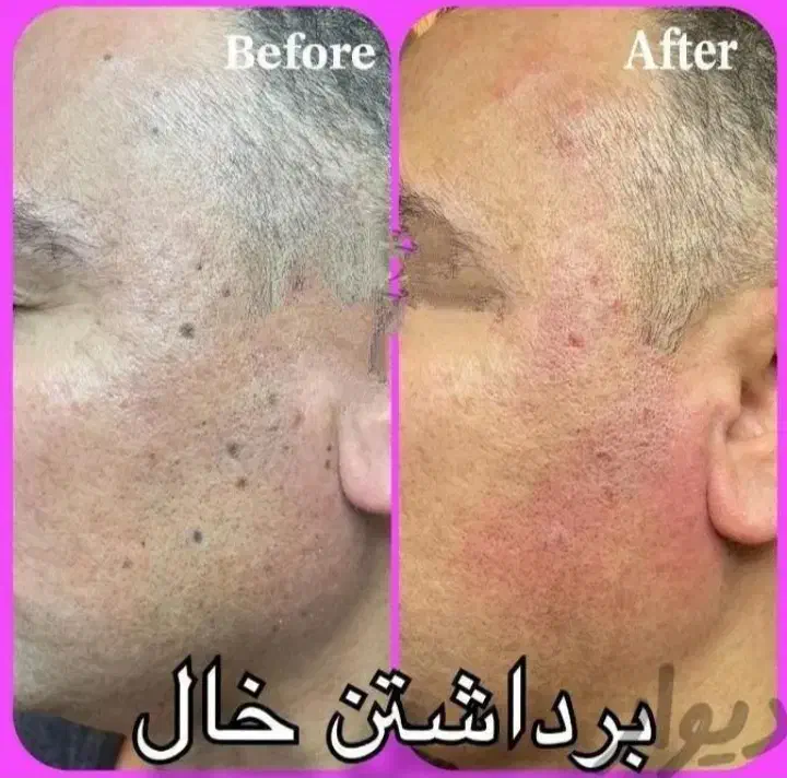 برداشت خال زگیل میخچه ختنه در مطب|خدمات آرایشگری و زیبایی|قم, هفت تیر|دیوار