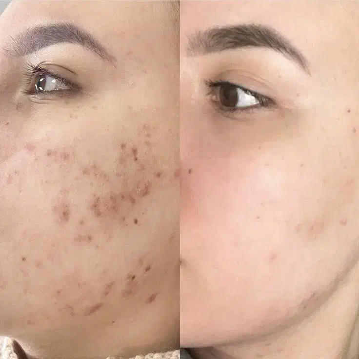 مدل پاکسازی پوست|خدمات آرایشگری و زیبایی|لاهیجان, حزین|دیوار