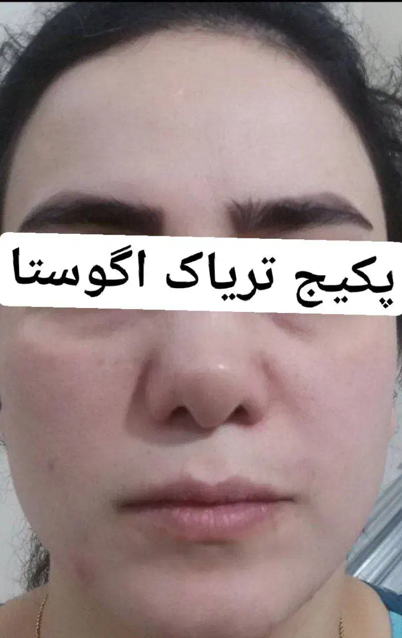 کرم ضدلک تریاک اگوستا|آرایشی، بهداشتی، درمانی|نیشابور, پاستور|دیوار