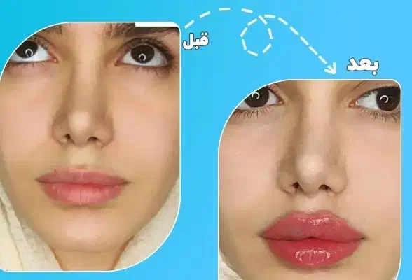 تزریق ژل و بوتاکس و لیزر موهای زائد|خدمات آرایشگری و زیبایی|شیراز, آزادگان|دیوار
