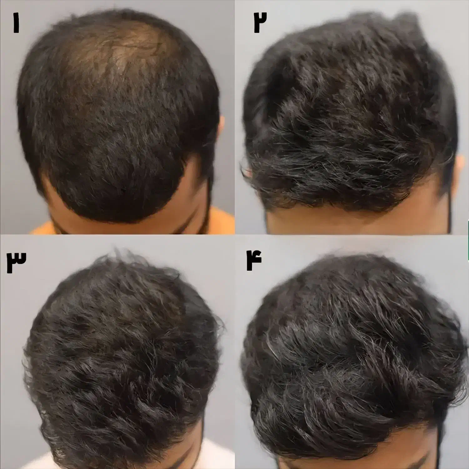 پی آر پی و مزوتراپی مو و ابرو|خدمات آرایشگری و زیبایی|اردبیل, |دیوار