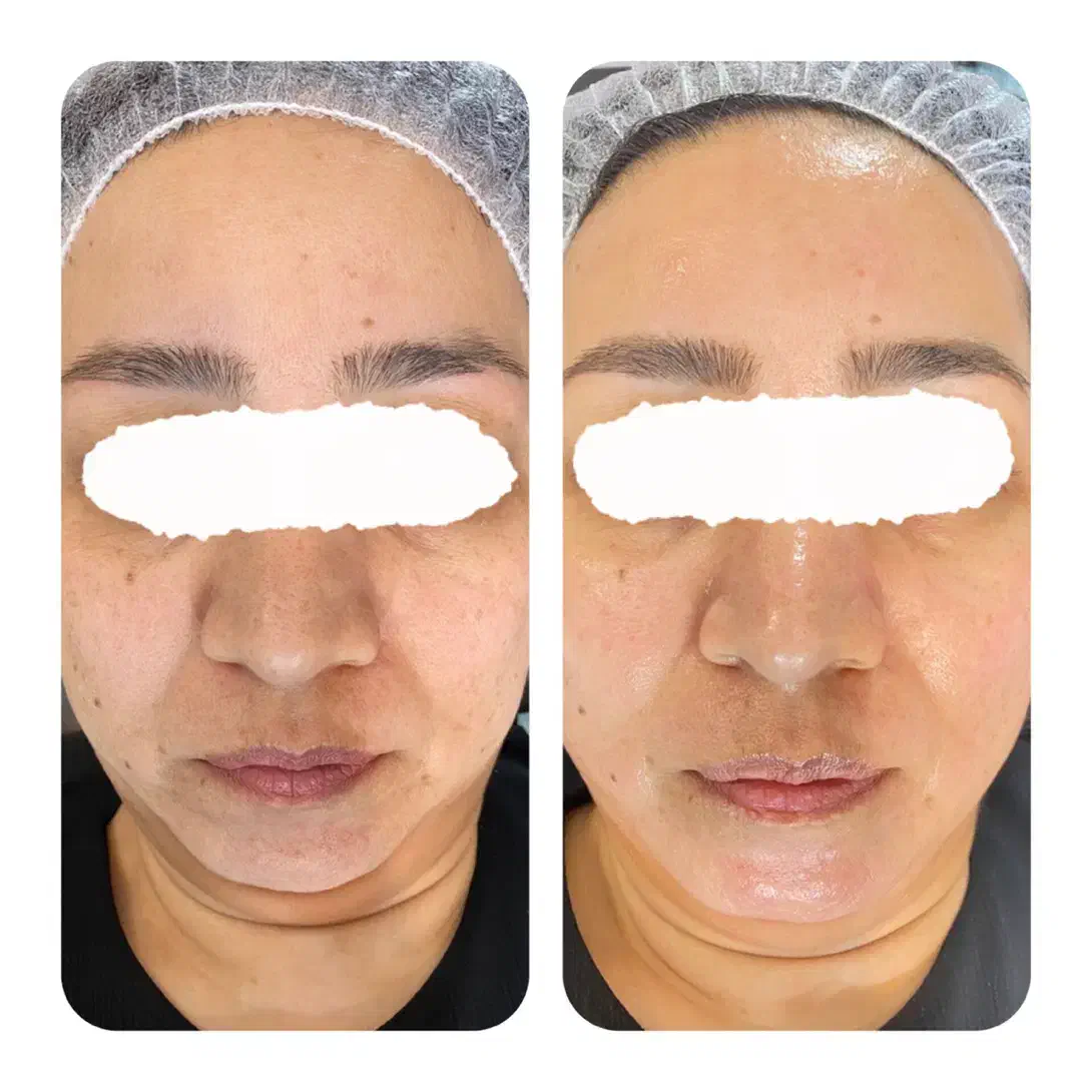 پاکسازی و فیشال پوست|خدمات آرایشگری و زیبایی|مشهد, امام رضا (ع)|دیوار