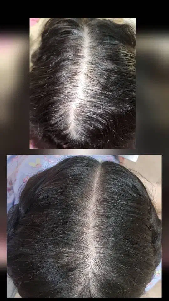 درمان ریزش مو|آرایشی، بهداشتی، درمانی|خوی, |دیوار