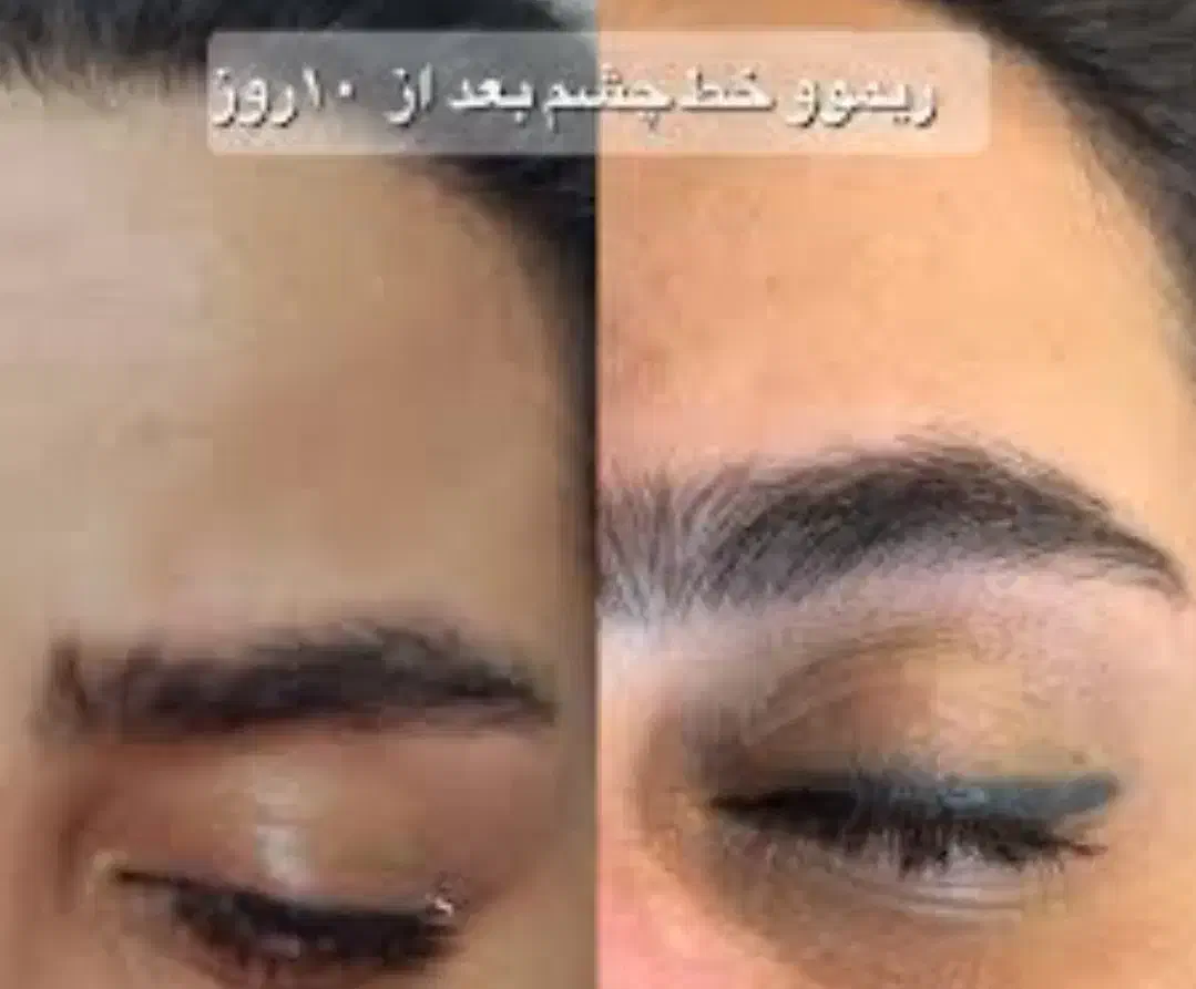 پاک کردن تتو با اسید میوه با بهترین مواد|خدمات آرایشگری و زیبایی|دماوند, دماوند|دیوار