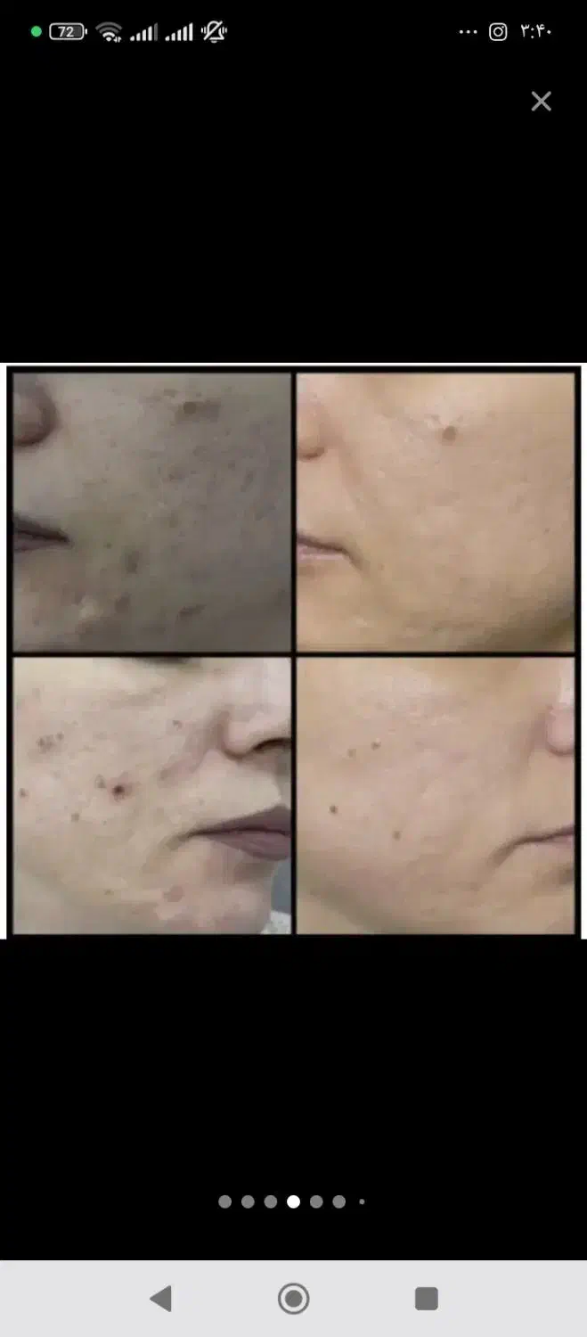 آموزش فیشیال تخصصی و مزوو|خدمات آموزشی|بهبهان, |دیوار